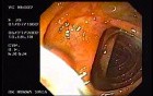A Tablet of Medicine in the Colon (1 of 2)