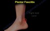 Plantar Fascitis and Heel Pain - Video Lecture 