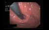 Esophageal Hernia In Endoscopy