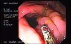 Zollinger- Ellison Syndrome - Gastric Ulcer with Gastrocolic Fistula (8 of 21)