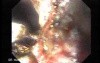 Long Standing Alcohol Abuse - Argon Plasm Coagulation, Part 3