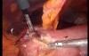 Gastrointestinal Stromal Tumor - GIST (26 of 65)