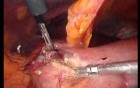 Gastrointestinal Stromal Tumor - GIST (26 of 65)