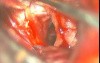 Brain Aneurysm - Anterior Choroidal Aneurysm - Microsurgical Clipping