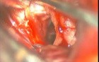 Brain Aneurysm - Anterior Choroidal Aneurysm - Microsurgical Clipping