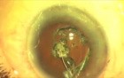 Quick Fugo Plasma Blade Capsulotomy. Closer to the Nanotechnology
