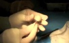 Thyroid Eye Disease: Repair Upper Of Lid Retraction W Scleral Graft