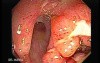 Severe case of Ischemic Colitis (3 of 19)
