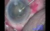 Cataract Surgery - Part 2/2