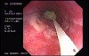 Foreign Body Retrieval - Steakhouse Sydrome