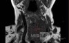 Esophageal Squamous Cell Carcinoma of the the upper third of the Esophagus that invades the subglotic (4 of 8)