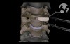 C3-C5 Anterior Cervical Discectomy And Fusion