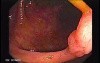 Sessile Tubulovillous Adenoma (2 of 13)