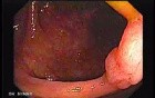 Sessile Tubulovillous Adenoma (2 of 13)