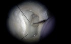 Maxillary Molar MB2 Orifice - Microscope
