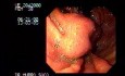 Erosioned Gastric Varix