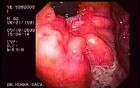 Assessment of Typical Parameters of Malignancy of the Ulcer by Use of Retroflexed View