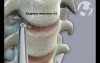 C4-7 Cervical Fusion