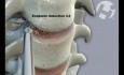 C4-7 Cervical Fusion