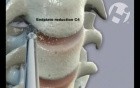 C4-7 Cervical Fusion