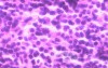 Lymphoma B small cells of the Jejuno (8 of 10)