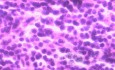 Lymphoma B small cells of the Jejuno (8 of 10)