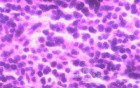 Lymphoma B small cells of the Jejuno (8 of 10)