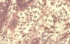 High power view of brown pigment inside of macrophages
 at the lamina propria 2