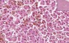 Liver, Lymph Node - Hemochromatosis - Hemosiderosis