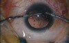 Phacoemulsification With Posterior Capsular Polishing