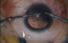 Phacoemulsification With Posterior Capsular Polishing