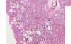 Diffuse interstitial fibrosis - Histopathology - Lung