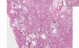 Diffuse interstitial fibrosis - Histopathology - Lung