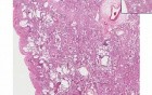 Diffuse interstitial fibrosis - Histopathology - Lung