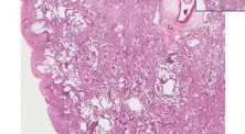 Diffuse interstitial fibrosis - Histopathology - Lung