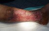 Atrophic Lower Leg Ulceration - Stage II