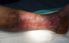 Atrophic Lower Leg Ulceration - Stage II