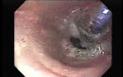 Achalasia Residual Food (5 of 11)