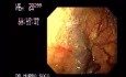 Gastric Fundus - Varices