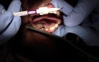Crown Tryin - Gingival Collapse - What Would You Do?