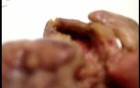 Toxic Dilatation Of The Colon Superimposed Pseudomembranous Colitis (12 z 17)