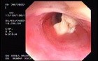 Zollinger- Ellison Syndrome - Gastric Ulcer with Gastrocolic Fistula (9 of 21)