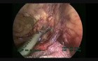 Laparoscopic Left Colectomy, Step By Step