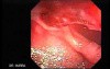 Duodenal Ulcer and Bleeding (2 of 23)