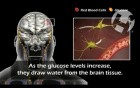 Hyperosmolar Coma