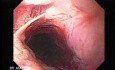 Perforation of a Esophageal Carcinoma after the procedure with hydrostatic balloon dilation (1 of 12)