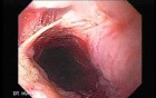 Perforation of a Esophageal Carcinoma after the procedure with hydrostatic balloon dilation (1 of 12)