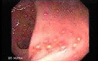 Endoscopic Image of Amebiasis Colitis
