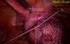Laparoscopic Pelvic Prolapse Surgery 