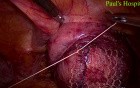 Laparoscopic Pelvic Prolapse Surgery 